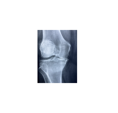 [Gene Online新聞]膝關節脂肪墊幹細胞結合外泌體綜合療法，在未來將會有相當大的前景