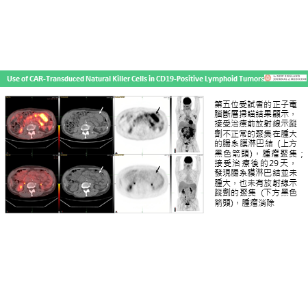 嵌合抗原受體NK細胞療法應用於表現CD19抗原的淋巴腫瘤